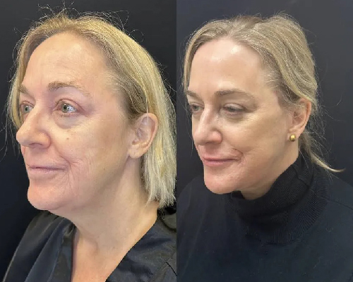 3 Months Postop Deep Plane Facelift