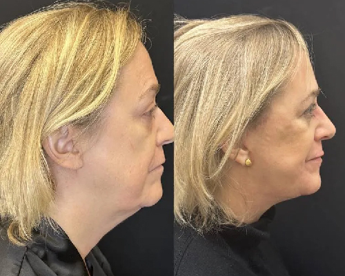 3 Months Postop Deep Plane Facelift Side Photo