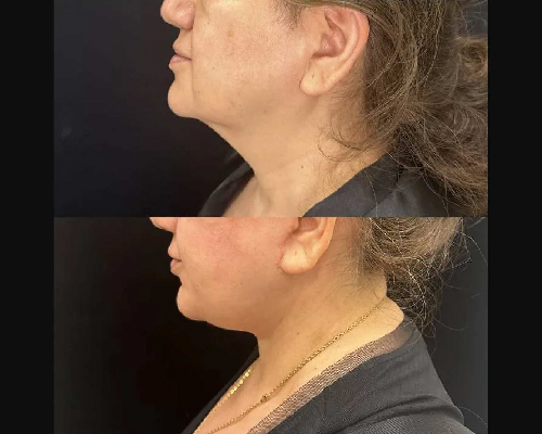 57-year-old Female Awake Deep Plane Facelift Left Side Profile