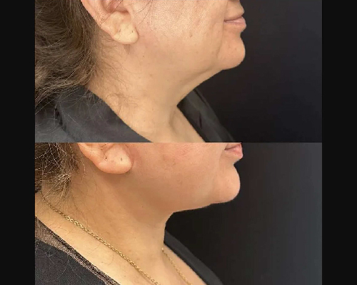 57-year-old Female Awake Deep Plane Facelift