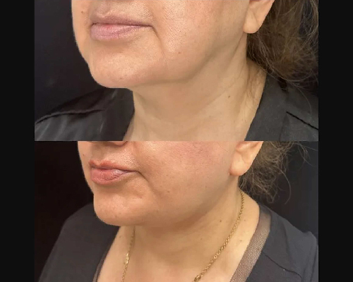 57-year-old Female Awake Deep Plane Facelift Left Oblique