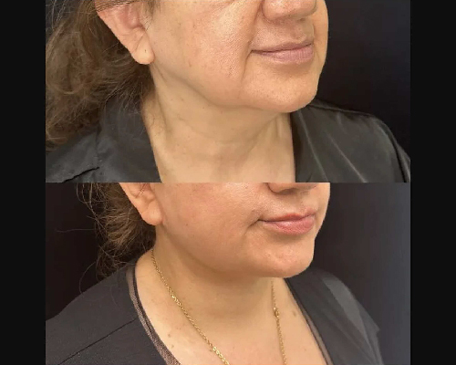 57-year-old Female Awake Deep Plane Facelift Right Oblique