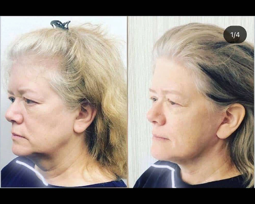 63-year-old Female High SMAS Facelift Postop Photos