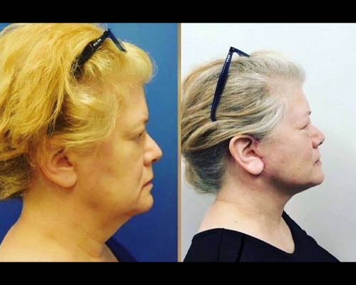 63-year-old Female High SMAS Facelift