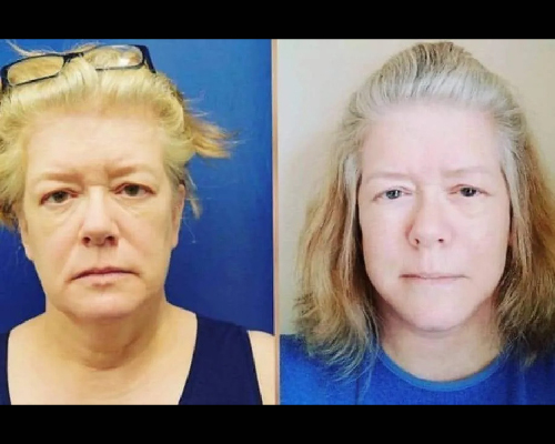 63-year-old Female High SMAS Facelift Before and After