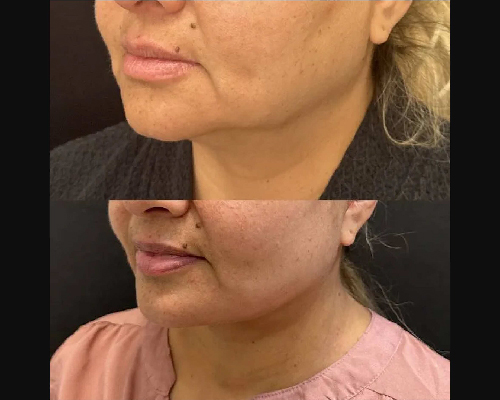 50-year-old Female Facelift Patient 3 Months Postop