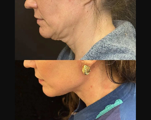 48-year-old Female Postop Facelift Photos NYC