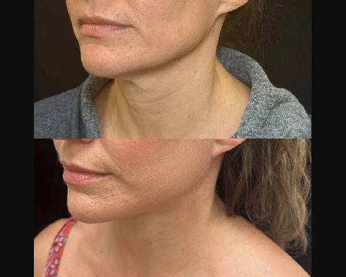 48-year-old Female Postop Facelift Photos