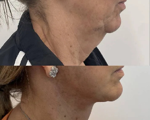 59-year-old Female Deep Plane Facelift Before and After Photos New York