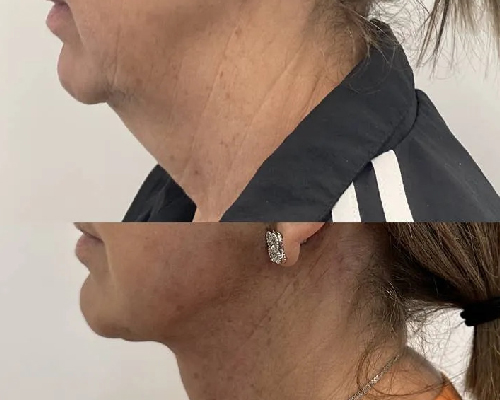 59-year-old Female Deep Plane Facelift Before and After