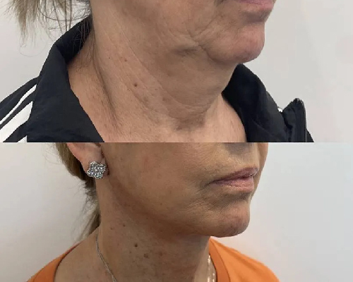 59-year-old Female Deep Plane Facelift Before and After Photos