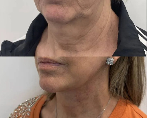 59-year-old Female Deep Plane Facelift Before and After Photos NYC