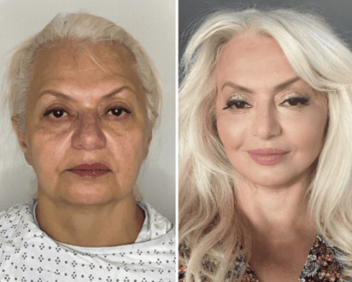 Deep Plane Facelift Before and After Front View by Dr. Mansher Singh