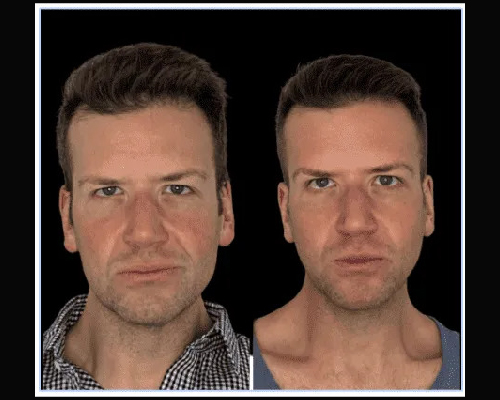 43-year-old Male Extended Deep Plane Neck Lift