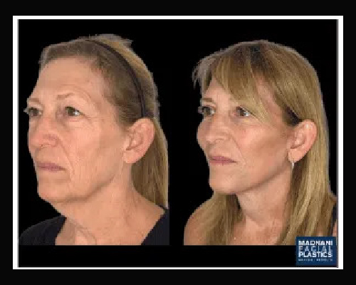 60-year-old Female Extended Deep Plane Facelift Results