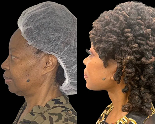 African American Facelift Before and After Side View