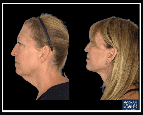 60-year-old Female Extended Deep Plane Facelift