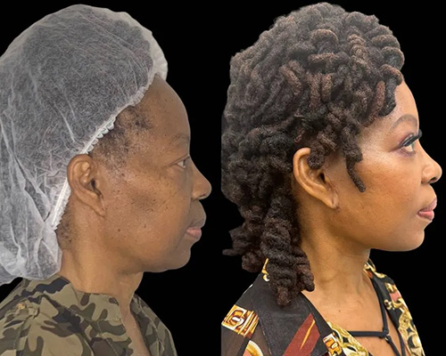 African American Facelift Before and After Right Side View