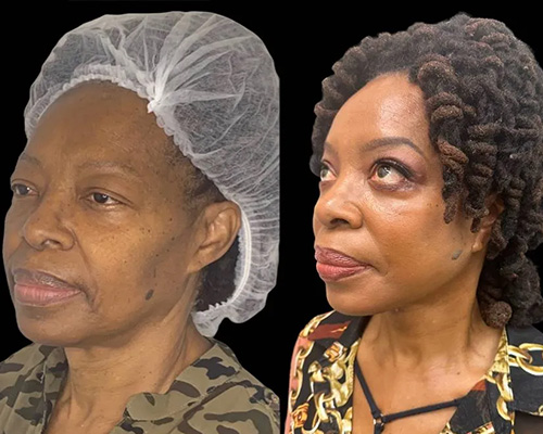 African American Facelift Before and After Left Side View