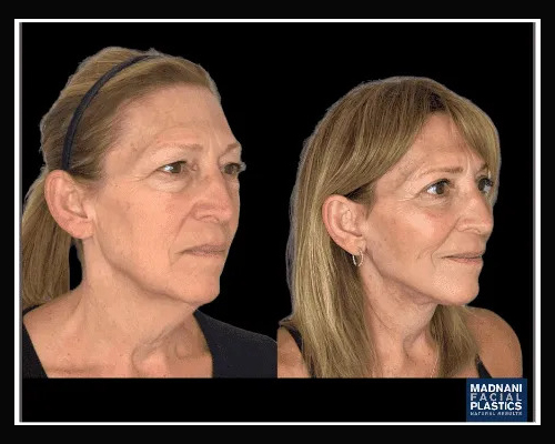 60-year-old Female Extended Deep Plane Facelift Photos