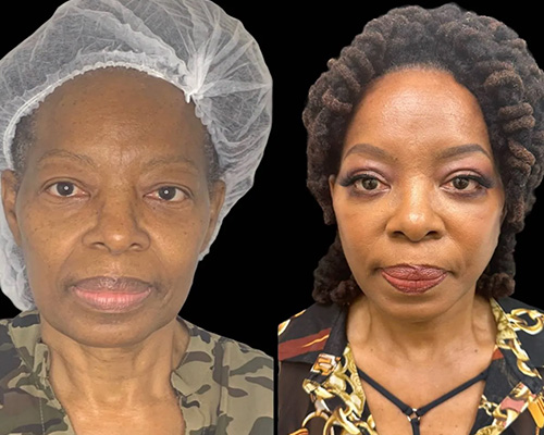 African American Facelift Before and After Front View