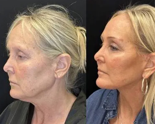 Deep Plane Facelift Before and After Left Side View