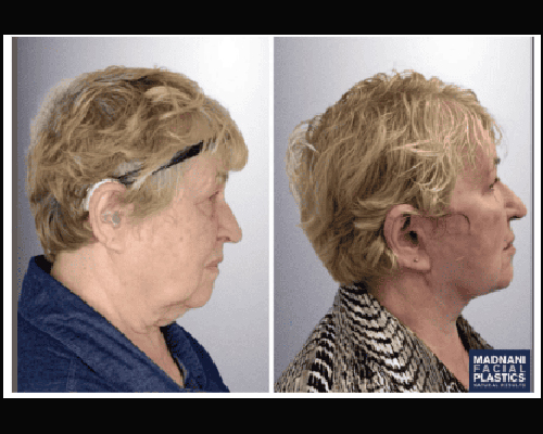 68-year-old Female Deep Plane Facelift Patient Photos