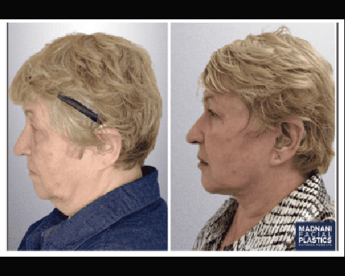 68-year-old Female Deep Plane Facelift Before and After