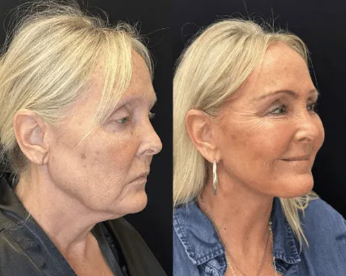 Deep PlaneFacelift Before and After Right Oblique Side View 2