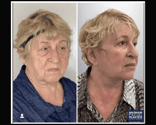 68-year-old Female Deep Plane Facelift Patient Photos NYC