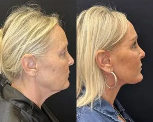 Deep Plane Facelift Before and After Right Side View