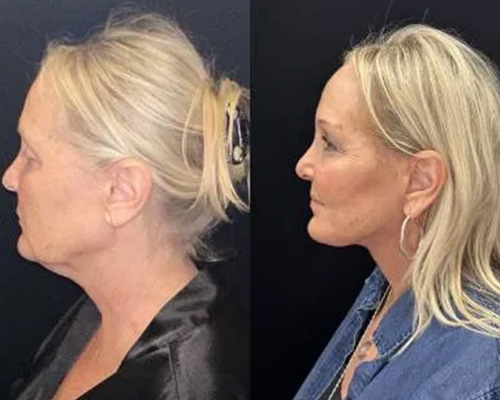 Deep Plane Facelift Before and After Left Side View