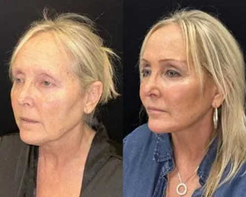 Deep Plane Facelift Before and After Left Oblique Side View