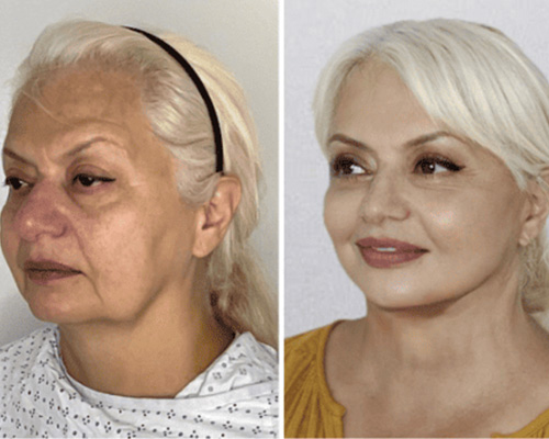 Deep Plane Facelift Before and After 3/4 View