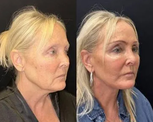 Deep Plane Facelift Before and After Right Oblique Side View