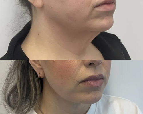 Deep PlaneFacelift Before and After Right Oblique Side View