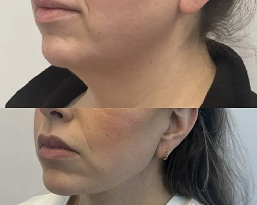 Deep PlaneFacelift Before and After Left Oblique Side View