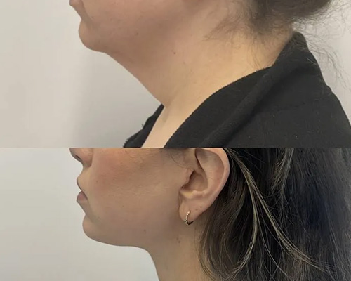 Deep PlaneFacelift Before and After Left Side View