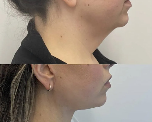 Deep PlaneFacelift Before and After Right Side View