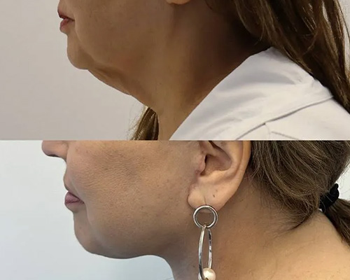 Awake Deep Plane Facelift Before and After Left Side View