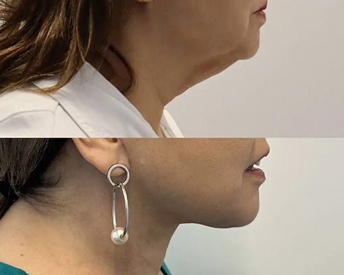 Awake Deep Plane Facelift Before and After Right Side View