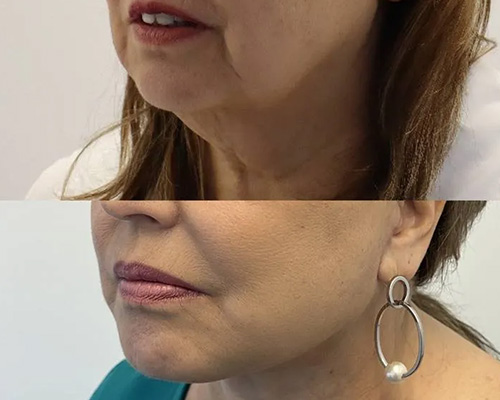 Awake Deep Plane Facelift Before and After Left Side Oblique View