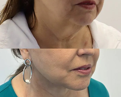 Awake Deep Plane Facelift Before and After Right Side Oblique View