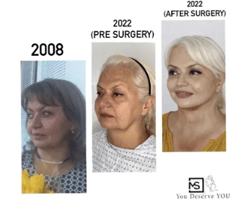 Deep Plane Facelift before and after transformation photos