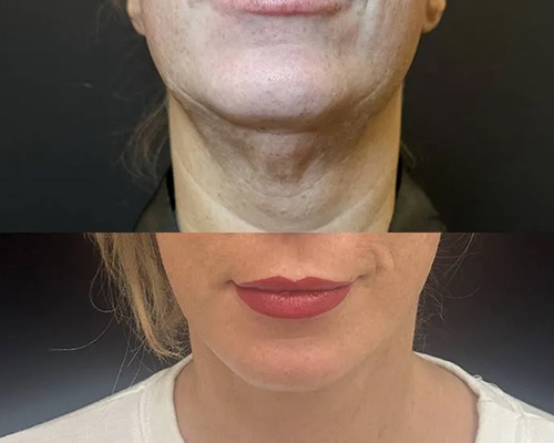 Awake necklift Before and After Front View