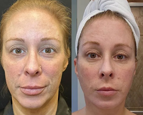 Awake Deep Plane Facelift and Necklift Before and After Front View 2