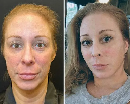 Awake Deep Plane Facelift and Necklift Before and After Front View