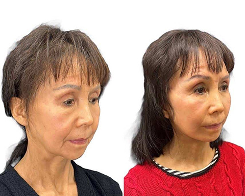 Deep Plane Facelift Before and After Right Side Oblique View