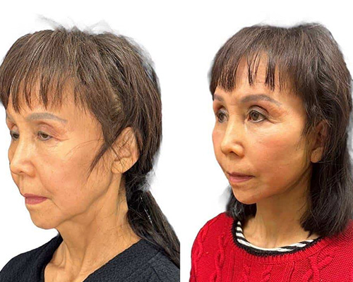 Deep Plane Facelift Before and After Left Side Oblique View