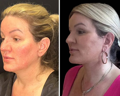 Awake Deep Plane Facelift and Necklift Left Oblique Side Photos